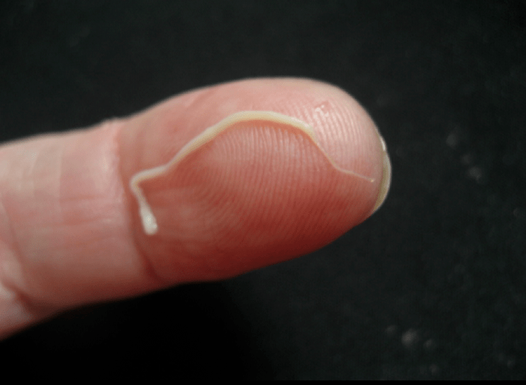 parasito de vermes redondos do corpo humano